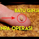 Illustration for article titled Akibat Penyakit Kencing Batu